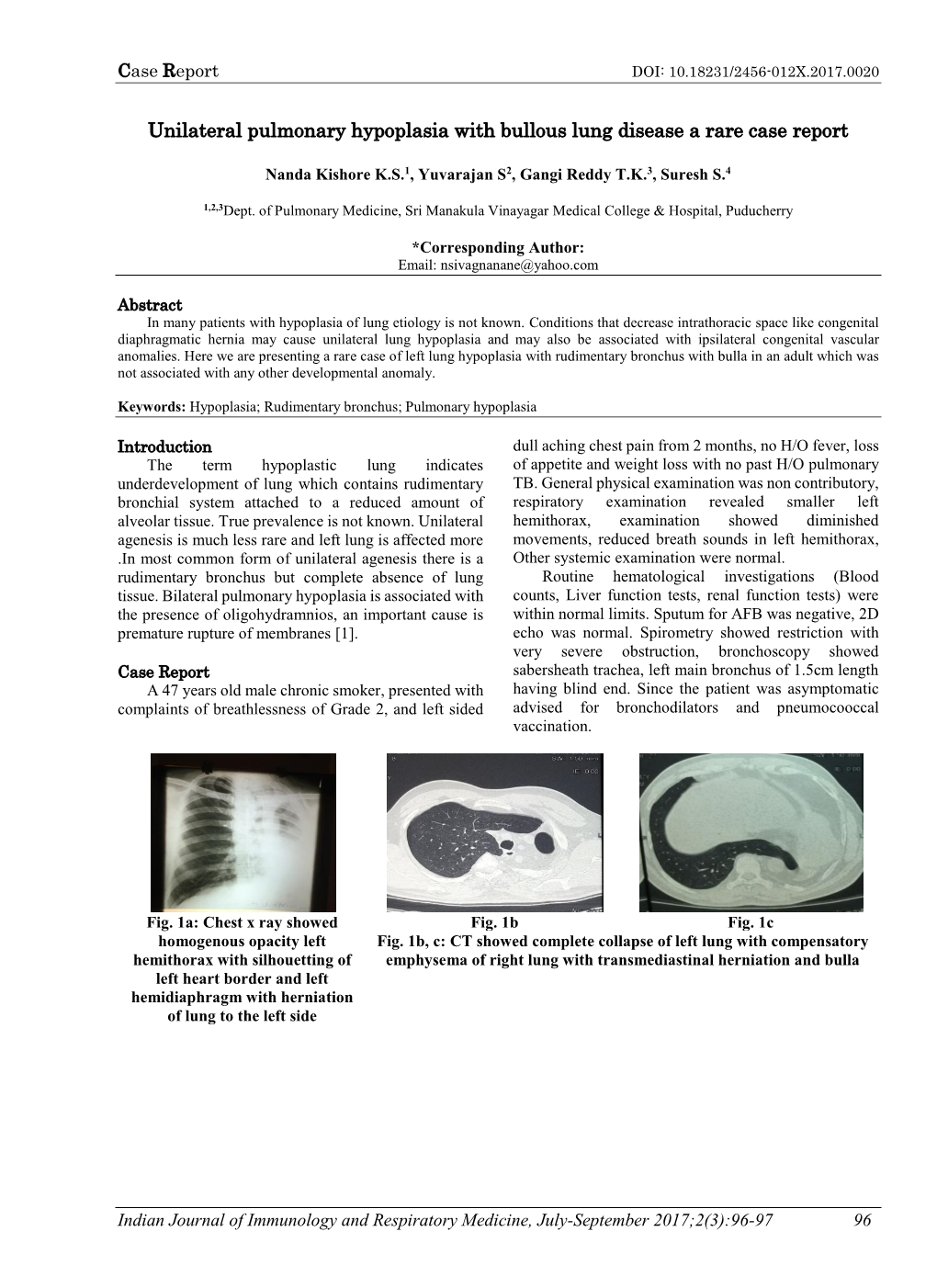 Unilateral Pulmonary Hypoplasia with Bullous Lung Disease a Rare Case Report