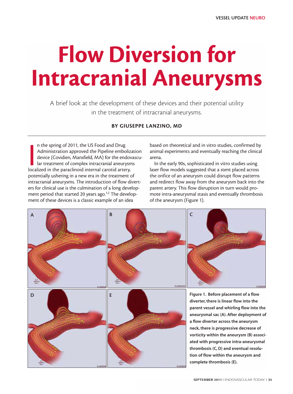 Flow Diversion for Intracranial Aneurysms