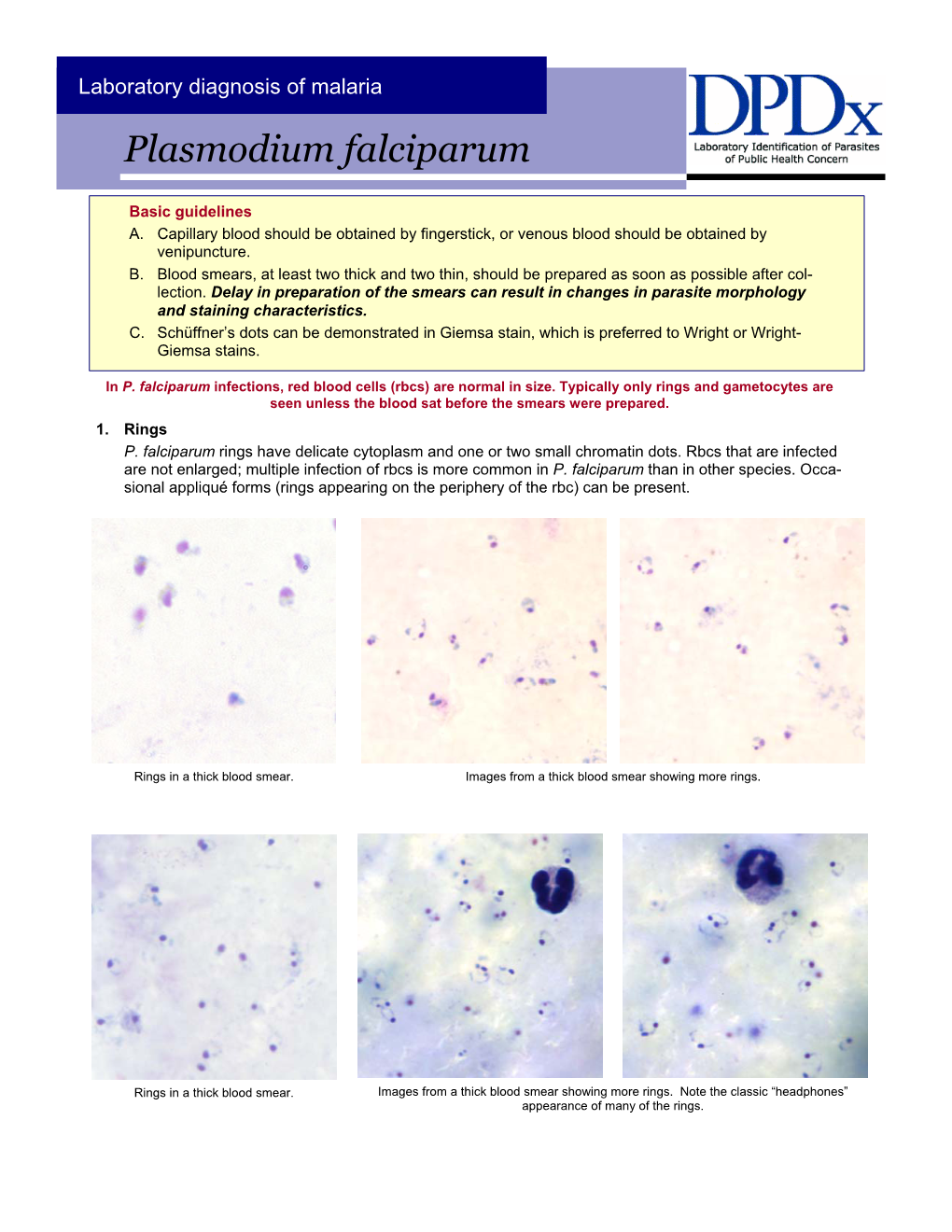 Laboratory Diagnosis of Plasmodium Falciparum Cdc-Pdf