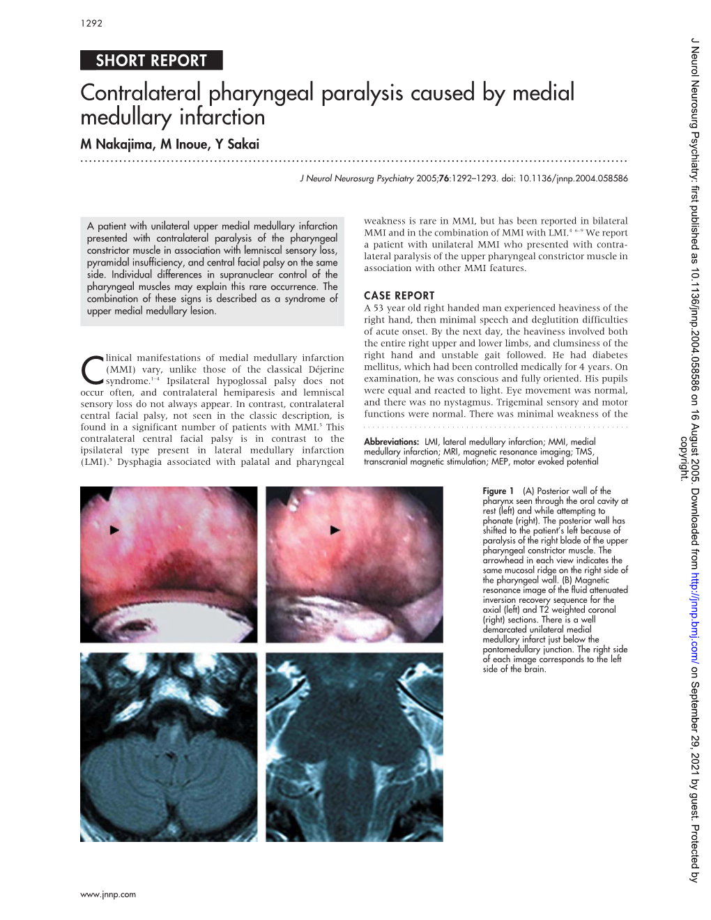 Contralateral Pharyngeal Paralysis Caused by Medial Medullary Infarction M Nakajima, M Inoue, Y Sakai