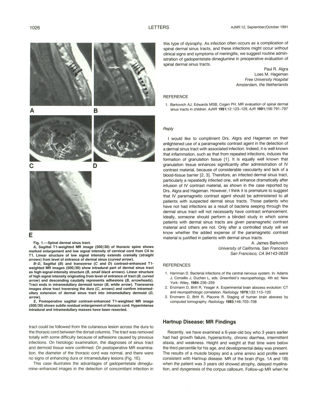 Hartnup Disease: MR Findings Tract Could Be Followed from the Cutaneous Lesion Across the Dura to the Thoracic Cord Between the Dorsal Columns