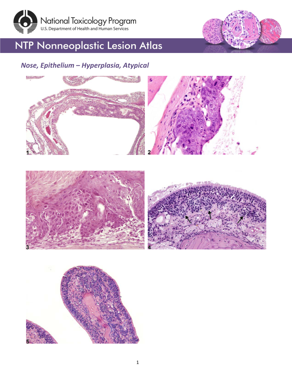 Nose, Epithelium – Hyperplasia, Atypical