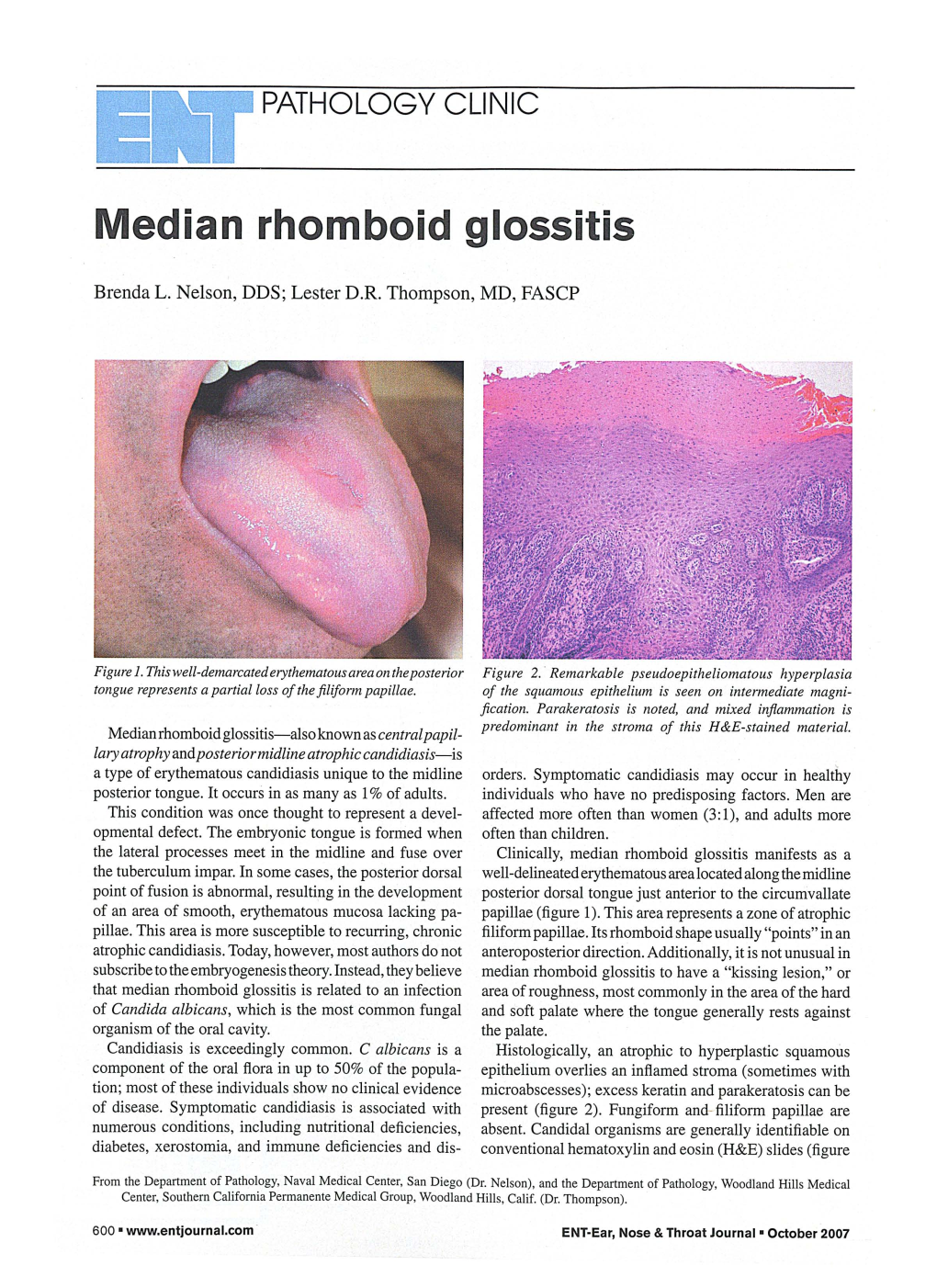 Median Rhomboid Glossitis