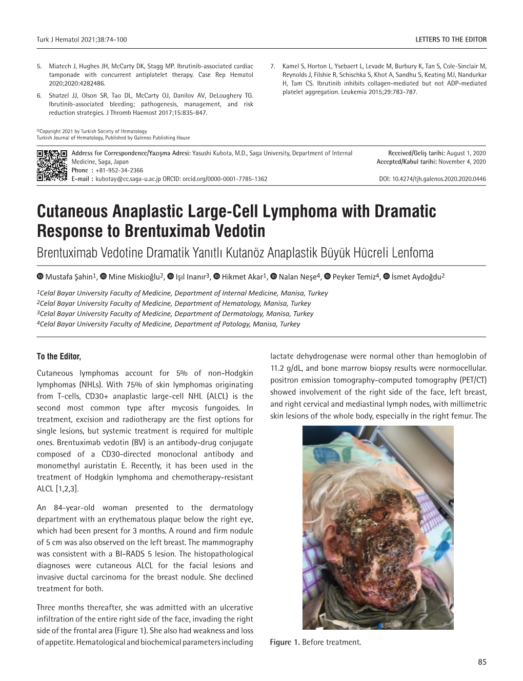 Cutaneous Anaplastic Large-Cell Lymphoma with Dramatic Response to Brentuximab Vedotin Brentuximab Vedotine Dramatik Yanıtlı Kutanöz Anaplastik Büyük Hücreli Lenfoma