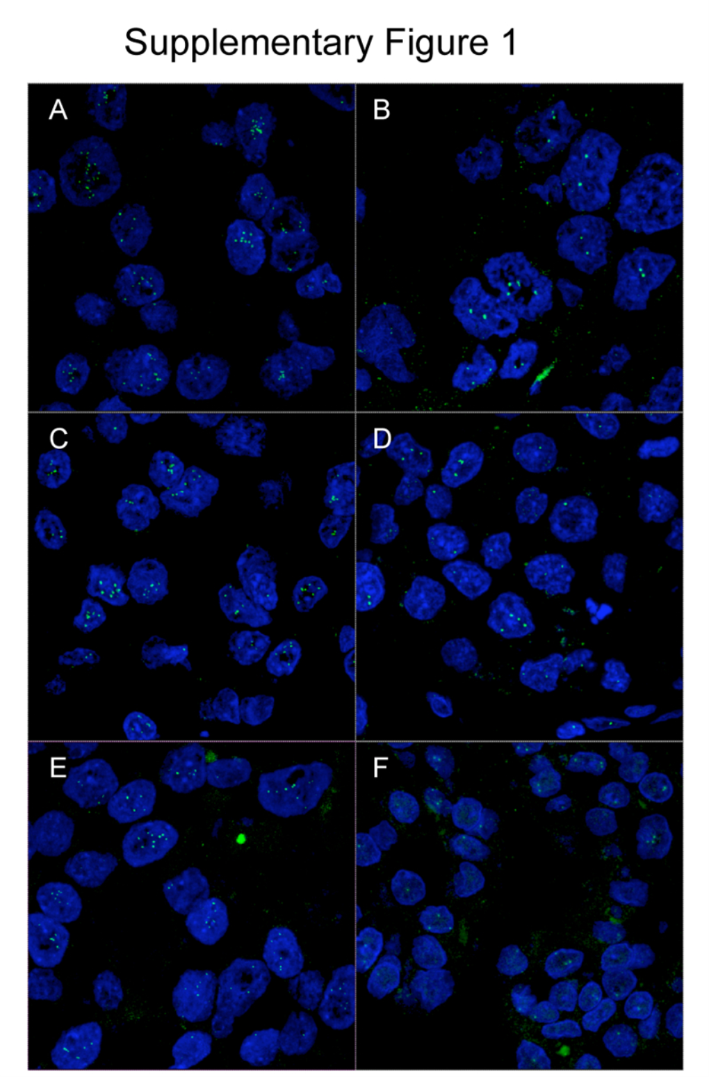 (E, F). Ovarian Clear Cell Carcinomas Harbouring Amplification of 19Q13.2
