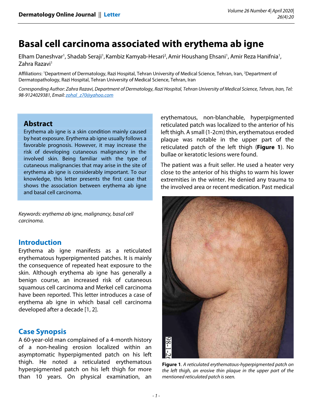 Basal Cell Carcinoma Associated With Erythema Ab Igne Docslib