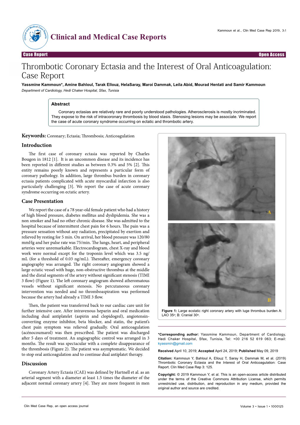 Thrombotic Coronary Ectasia and the Interest Of