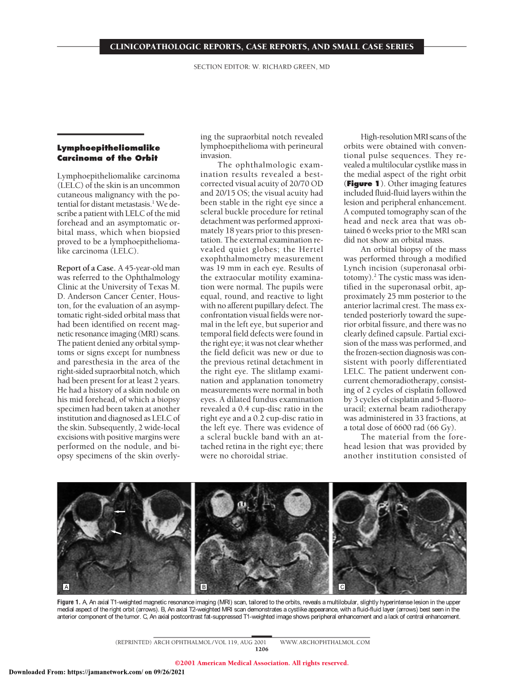 Anterior Ischemic Optic Neuropathy Following Acute Angle-Closure Glaucoma