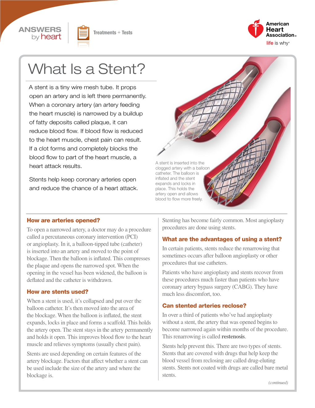 What Is a Stent?