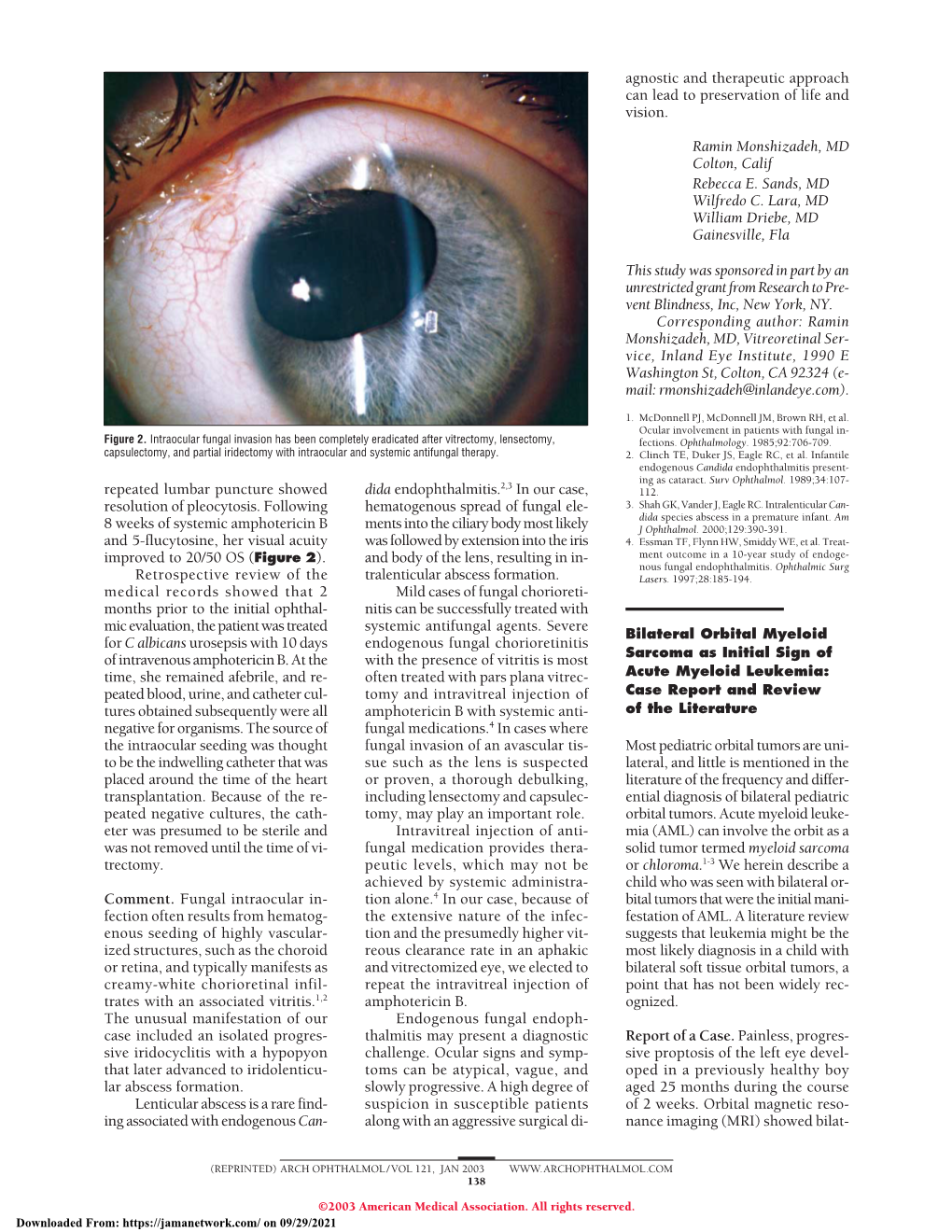 Bilateral Orbital Myeloid Sarcoma As Initial Sign of Acute Myeloid Leukemia