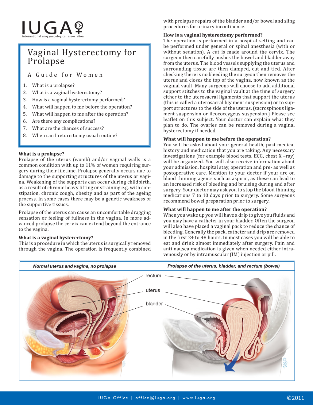 Vaginal Hysterectomy for Prolapse