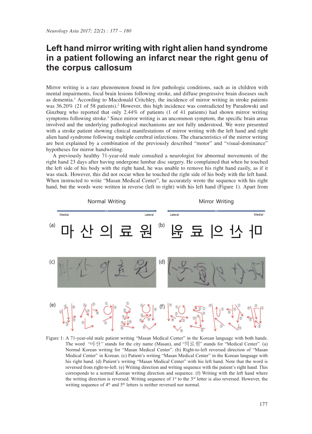 Left Hand Mirror Writing with Right Alien Hand Syndrome in a Patient Following an Infarct Near the Right Genu of the Corpus Callosum