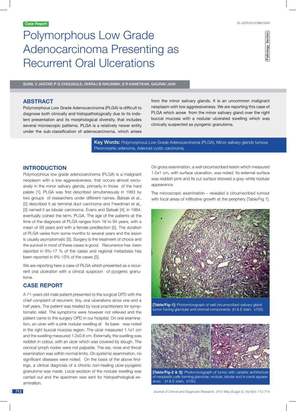 Polymorphous Low Grade Adenocarcinoma Presenting As Recurrent Oral Ulcerations P Athology Section