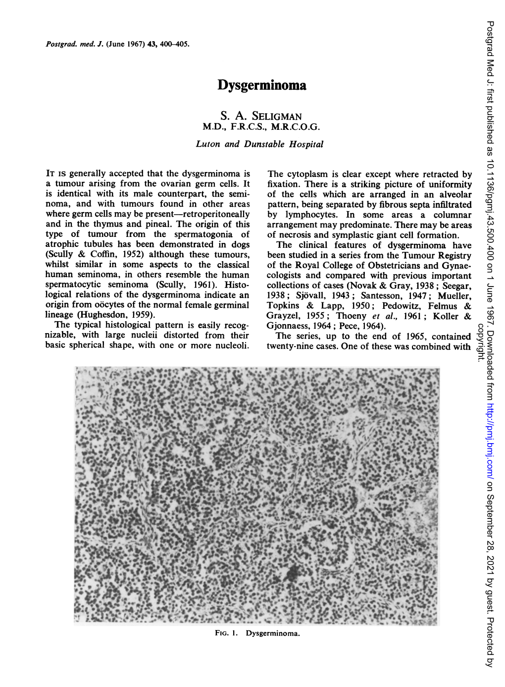 Dysgerminoma S