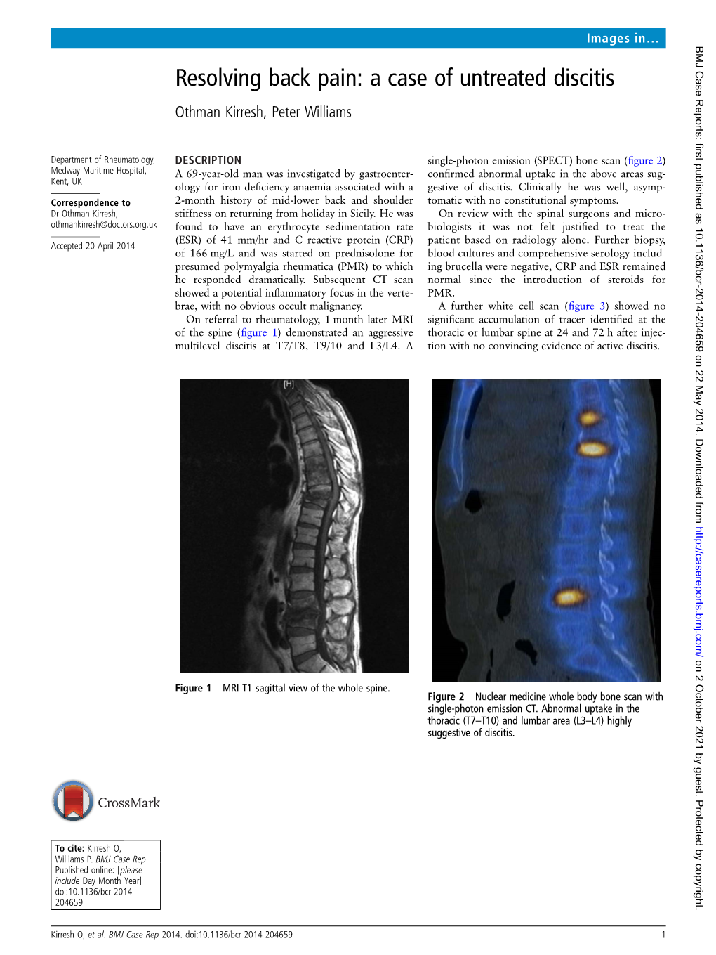 Resolving Back Pain: a Case of Untreated Discitis Othman Kirresh, Peter Williams