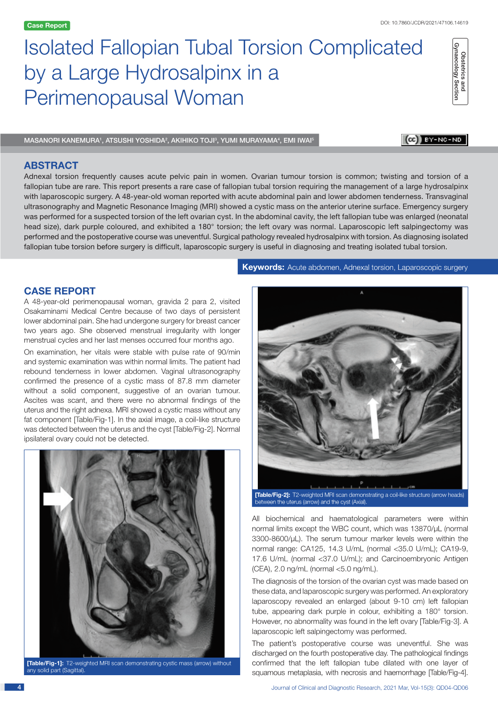 Isolated Fallopian Tubal Torsion Complicated by a Large Hydrosalpinx in a Perimenopausal Woman