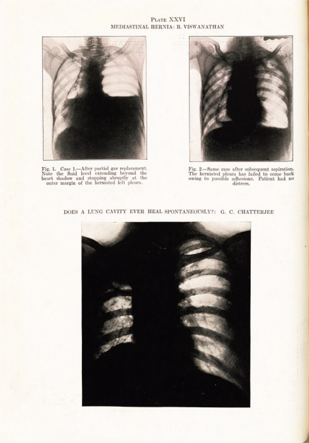 Does a Lung Cavity Ever Heal Spontaneously?: G