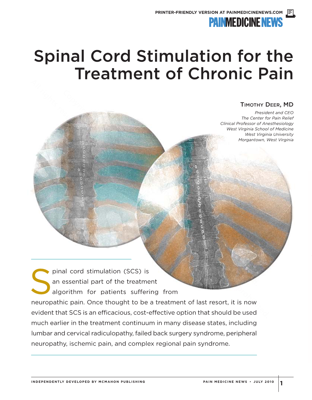 Spinal Cord Stimulation for the Treatment of Chronic Pain