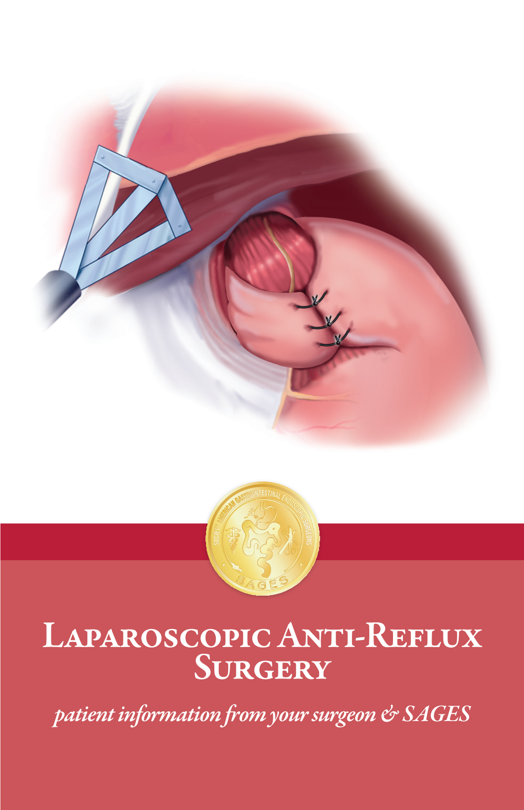 Laparoscopic Anti-Reflux Surgery Patient Information from Your Surgeon & SAGES
