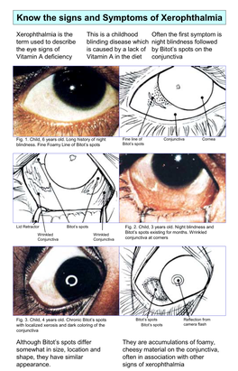 Know the Signs and Symptoms of Xerophthalmia