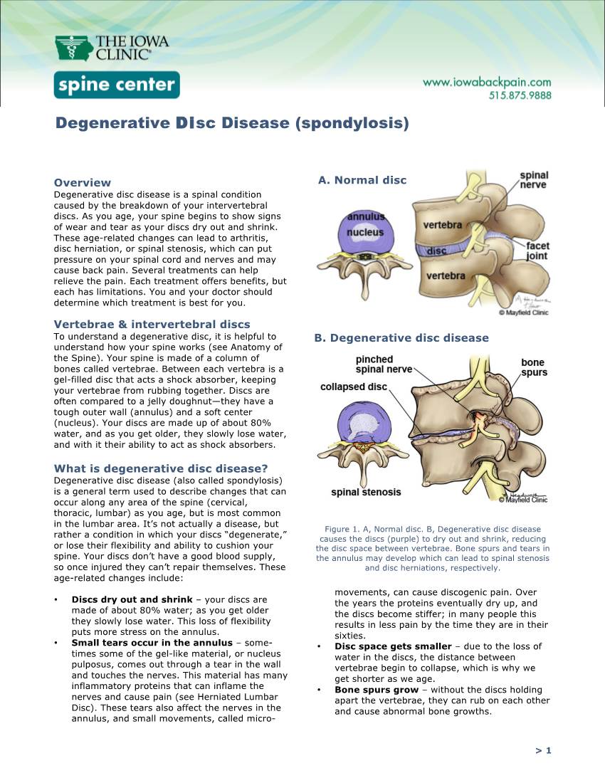 Degenerative Disc Disease (Spondylosis)