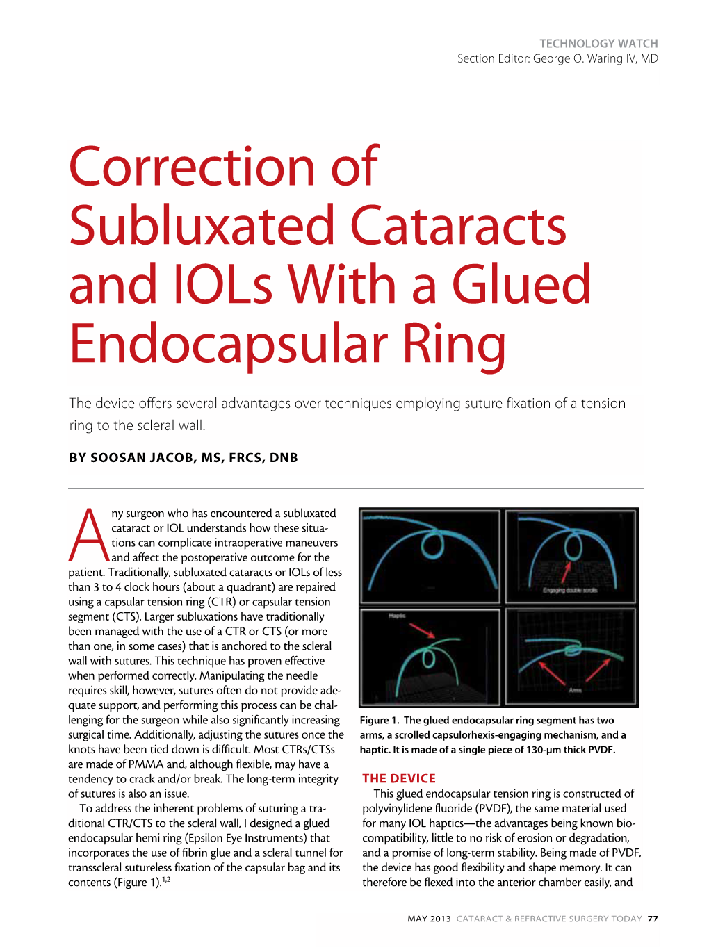 Correction of Subluxated Cataracts and Iols with a Glued Endocapsular Ring