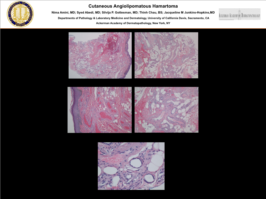 Cutaneous Angiolipomatous Hamartoma Nima Amini, MD; Syed Abedi, MD; Silvija P