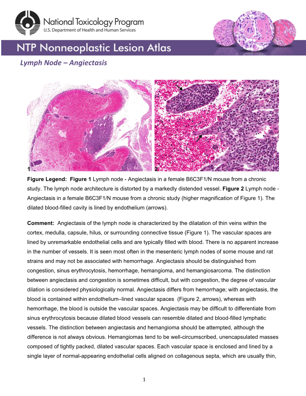 Lymph Node – Angiectasis