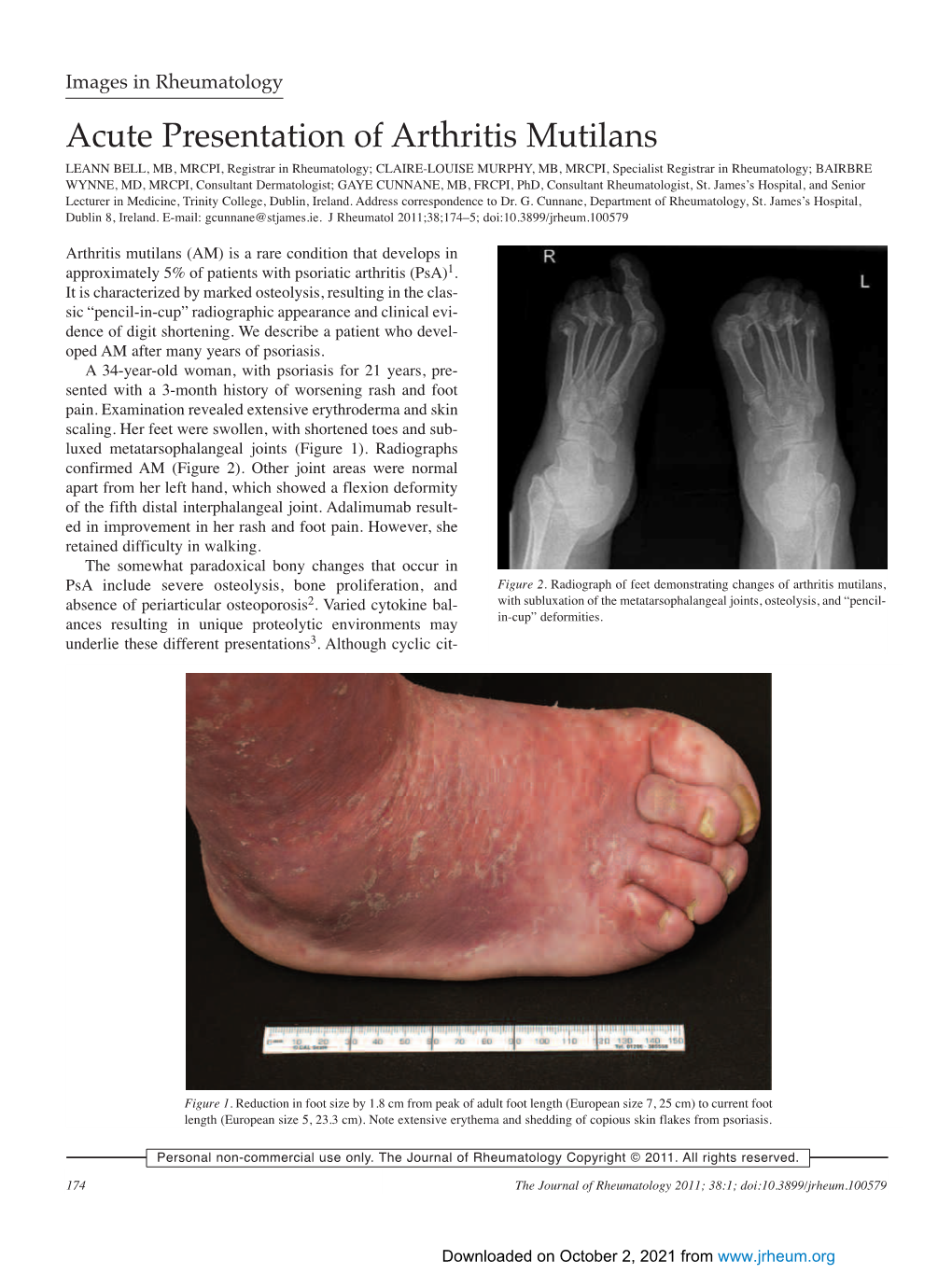 Acute Presentation of Arthritis Mutilans