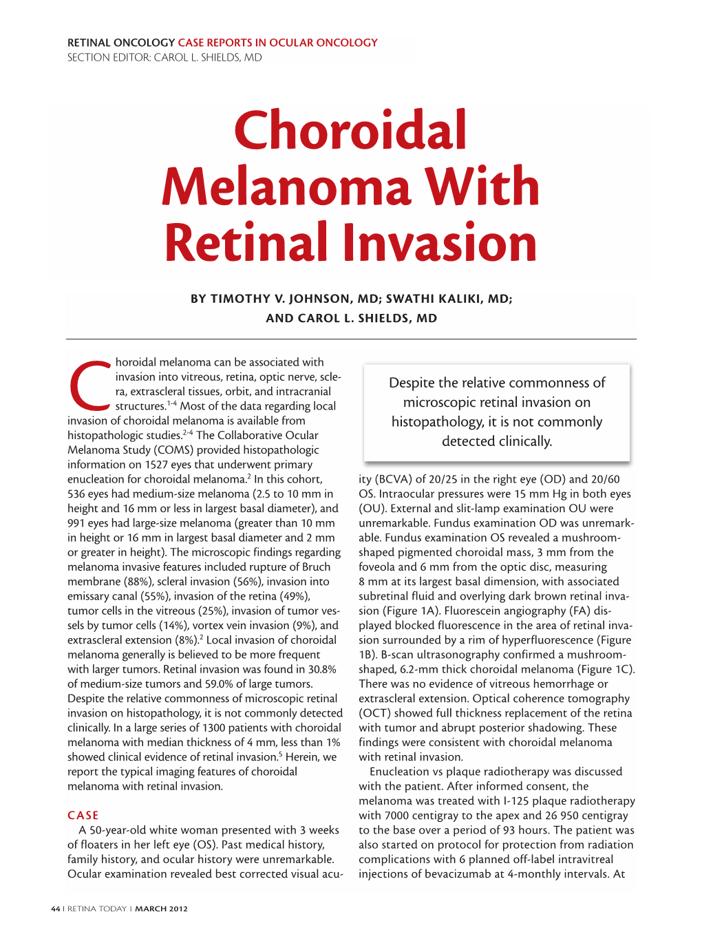 Choroidal Melanoma with Retinal Invasion