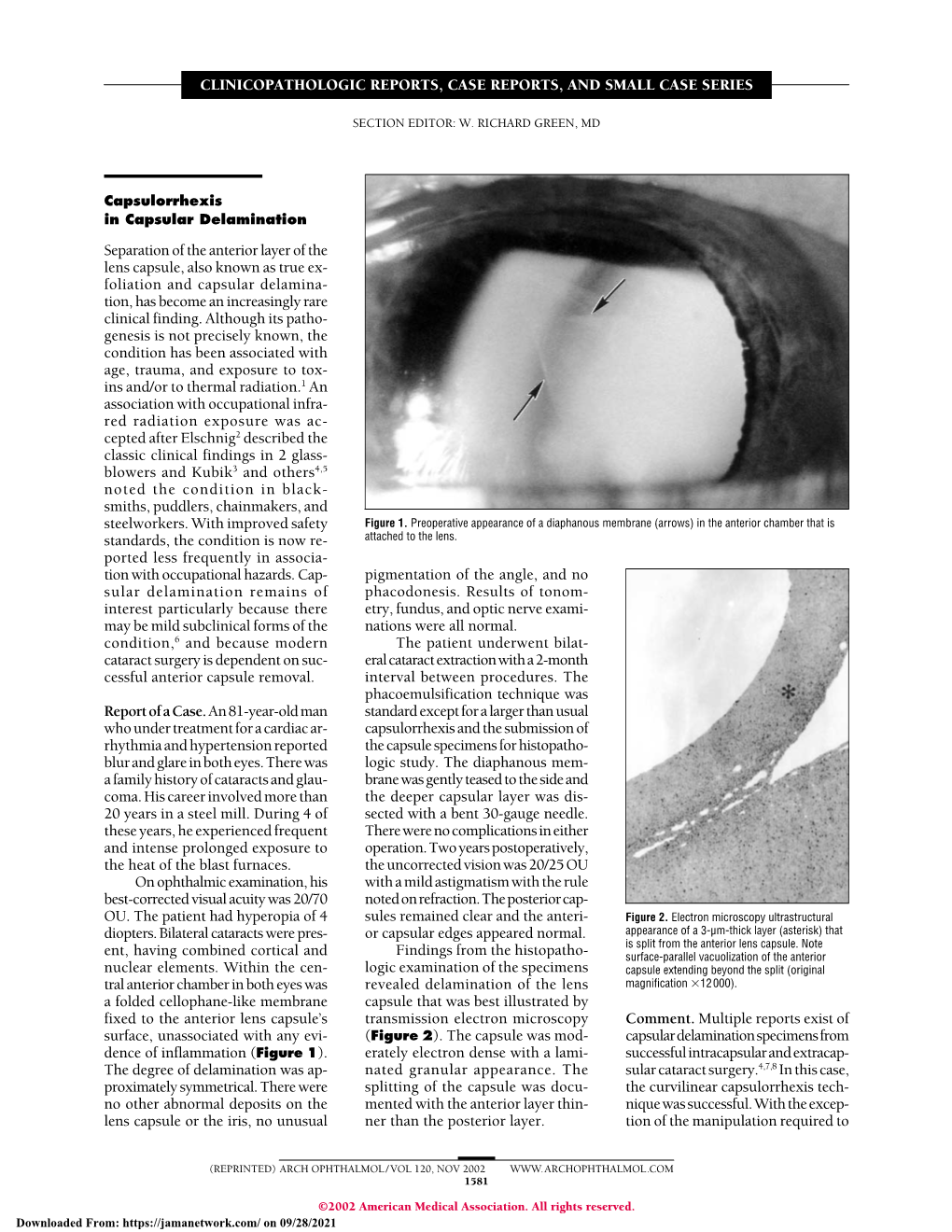 Capsulorrhexis in Capsular Delamination