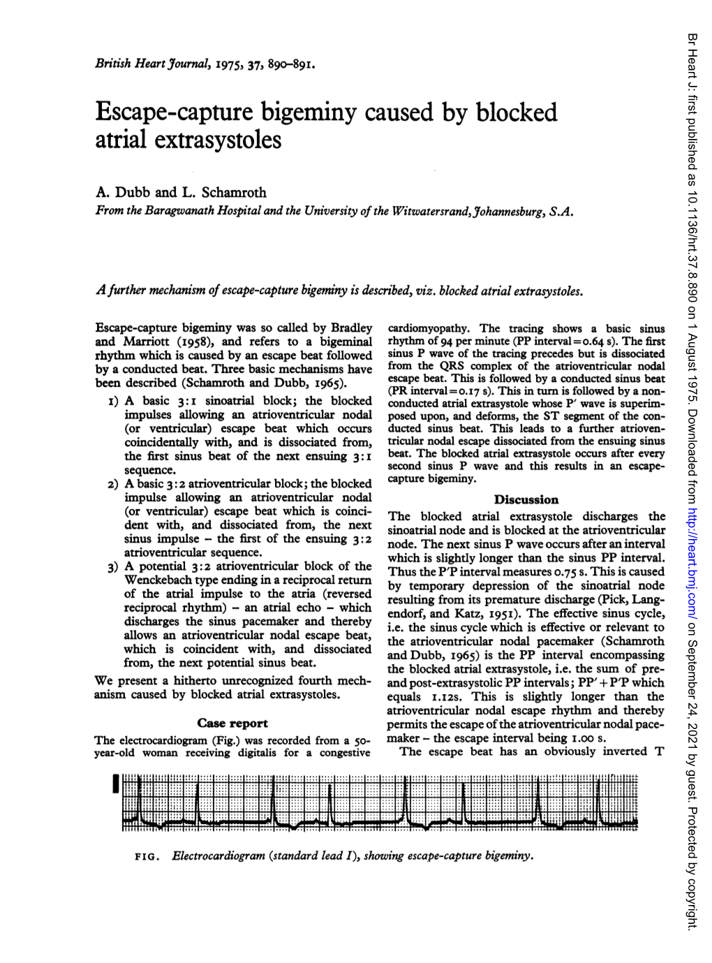 Escape-Capture Bigeminy Caused by Blocked Atrial Extrasystoles