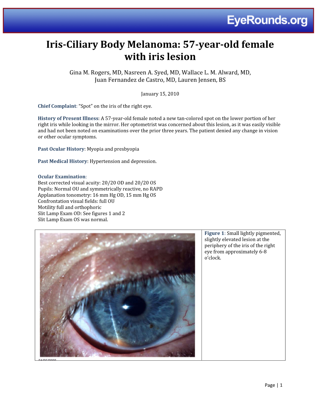 Iris-Ciliary Body Melanoma: 57-Year-Old Female with Iris Lesion