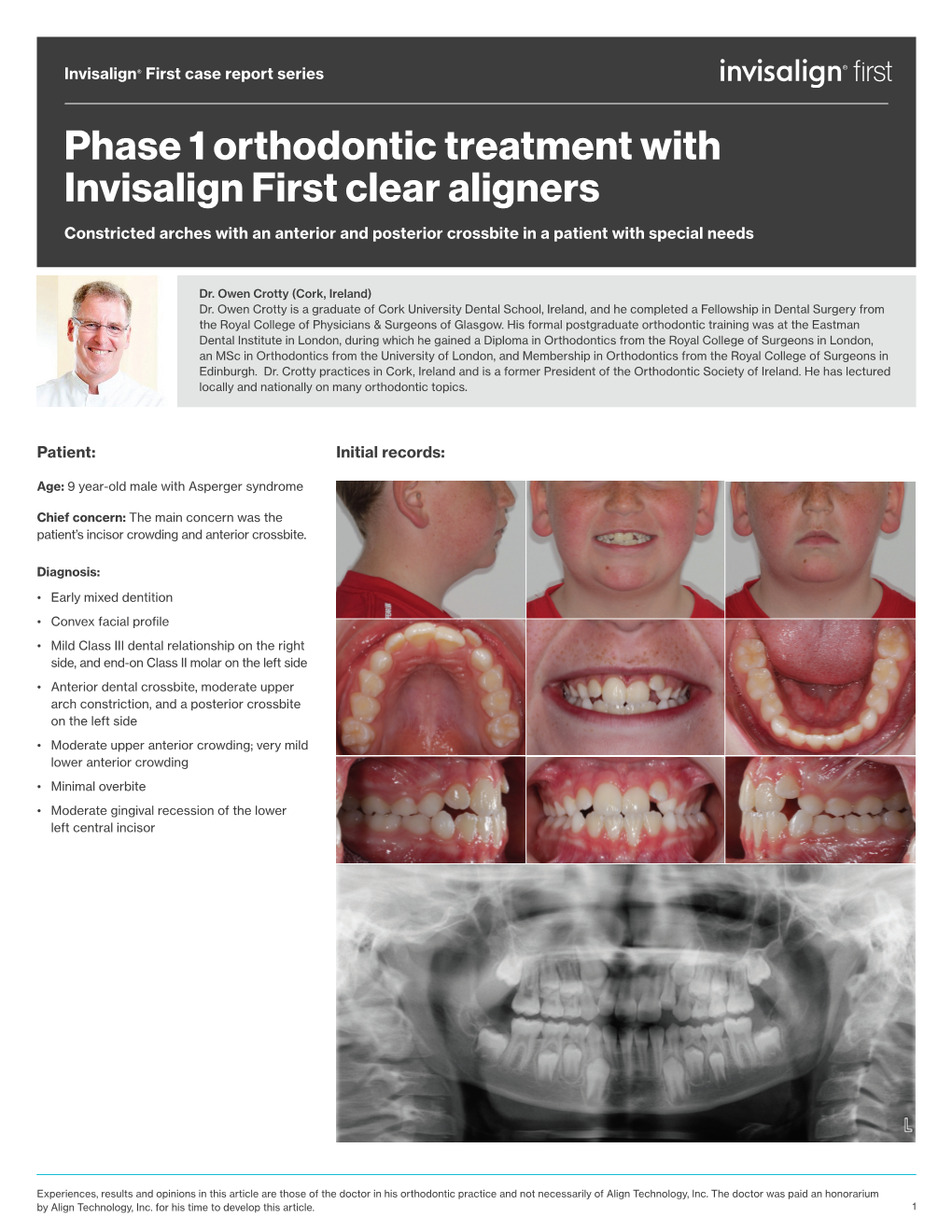 Phase 1 Orthodontic Treatment with Invisalign First Clear Aligners Constricted Arches with an Anterior and Posterior Crossbite in a Patient with Special Needs