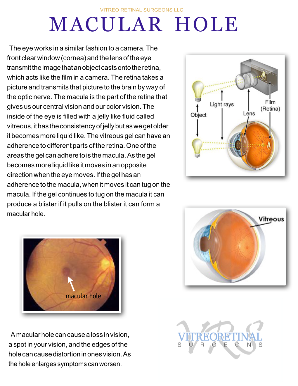 Macular Hole