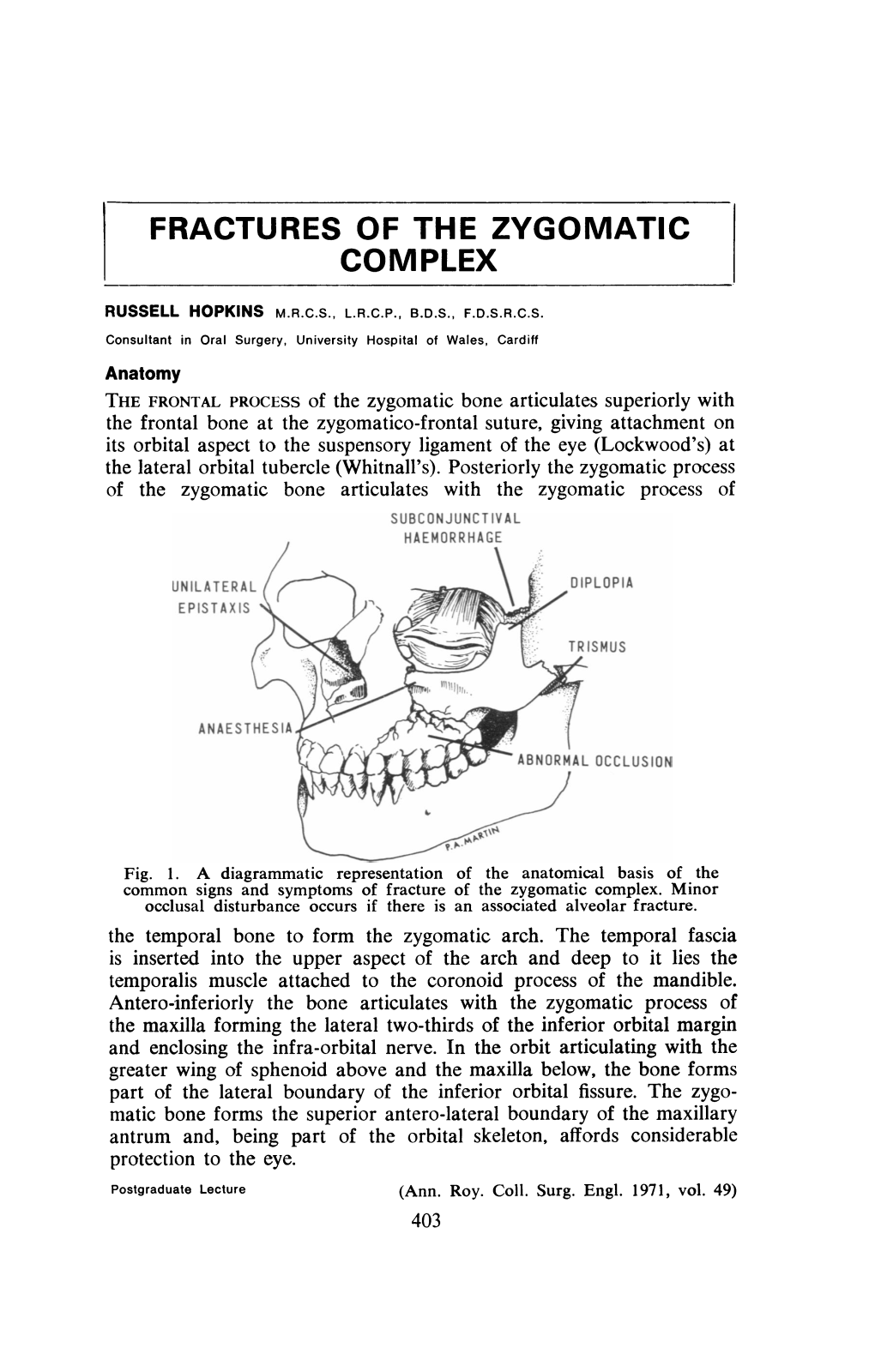 Fractures of the Zygomatic Complex