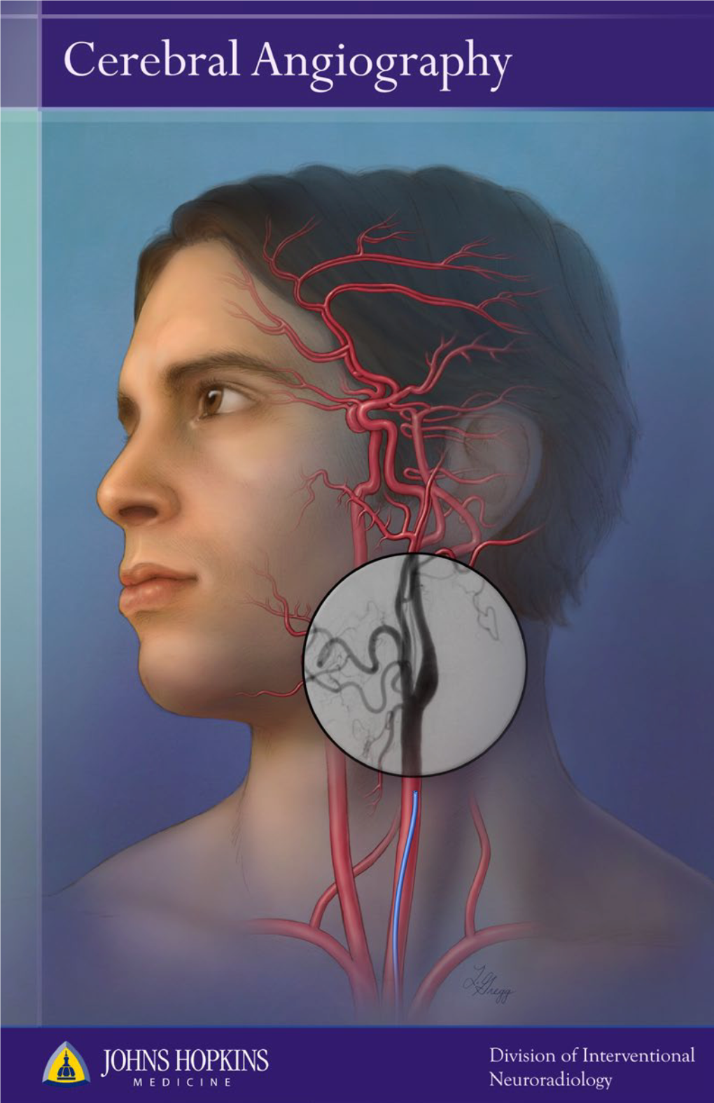 Cerebral-Angiography-Johns-Hopkins