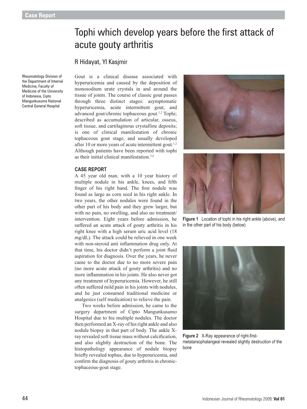 Tophi Which Develop Years Before the First Attack of Acute Gouty Arthritis