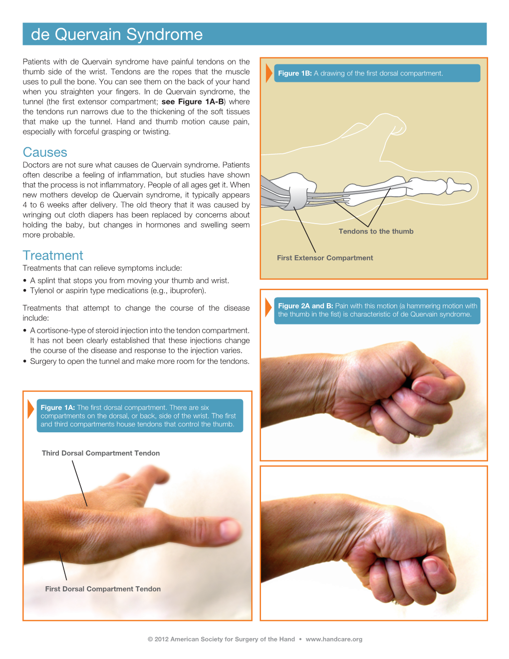 De Quervain Syndrome