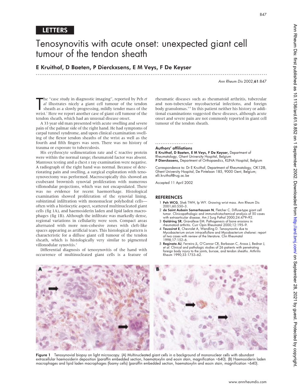 Unexpected Giant Cell Tumour of the Tendon Sheath E Kruithof, D Baeten, P Dierckxsens, E M Veys, F De Keyser