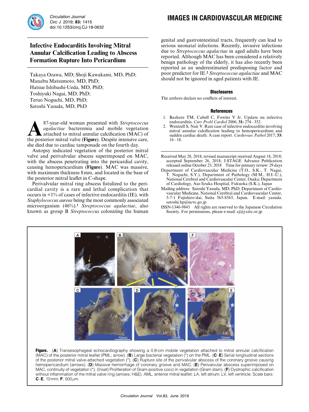 Infective Endocarditis Involving Mitral Annular Calcification