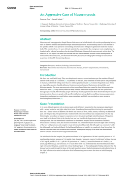 An Aggressive Case of Mucormycosis