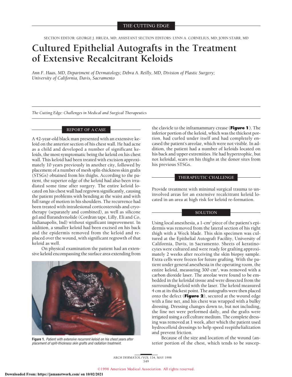 Cultured Epithelial Autografts in the Treatment of Extensive Recalcitrant Keloids