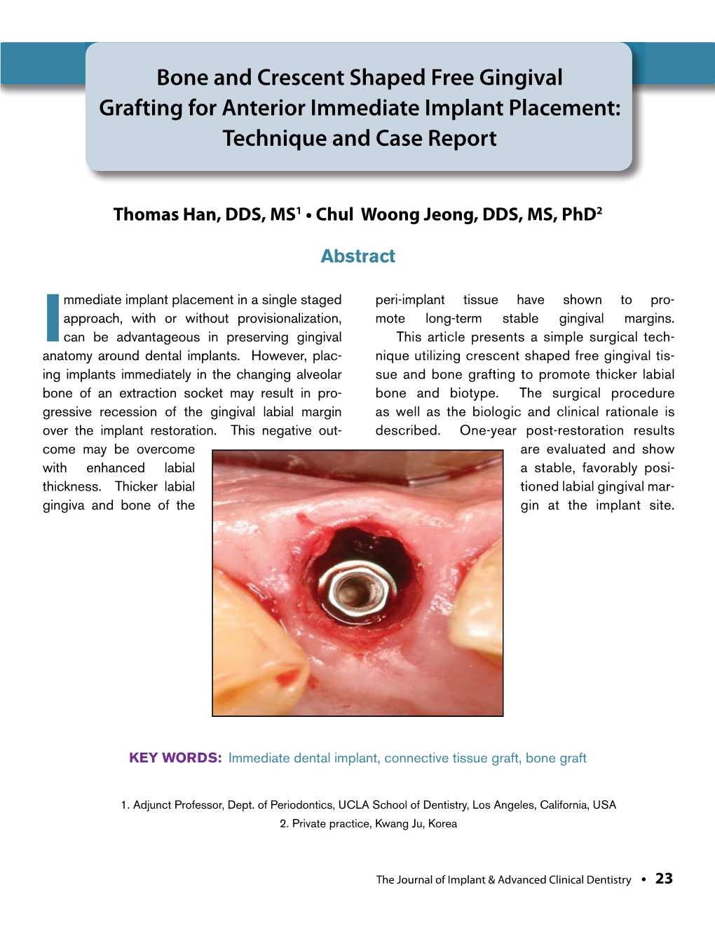 Bone and Crescent Shaped Free Gingival Grafting for Anterior Immediate Implant Placement: Technique and Case Report