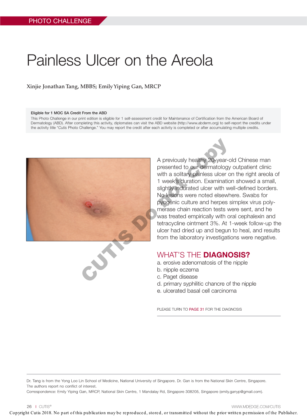 Painless Ulcer on the Areola