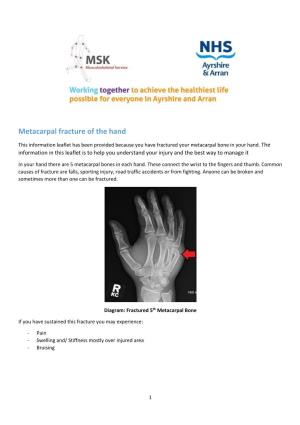 Metacarpal Fracture of the Hand