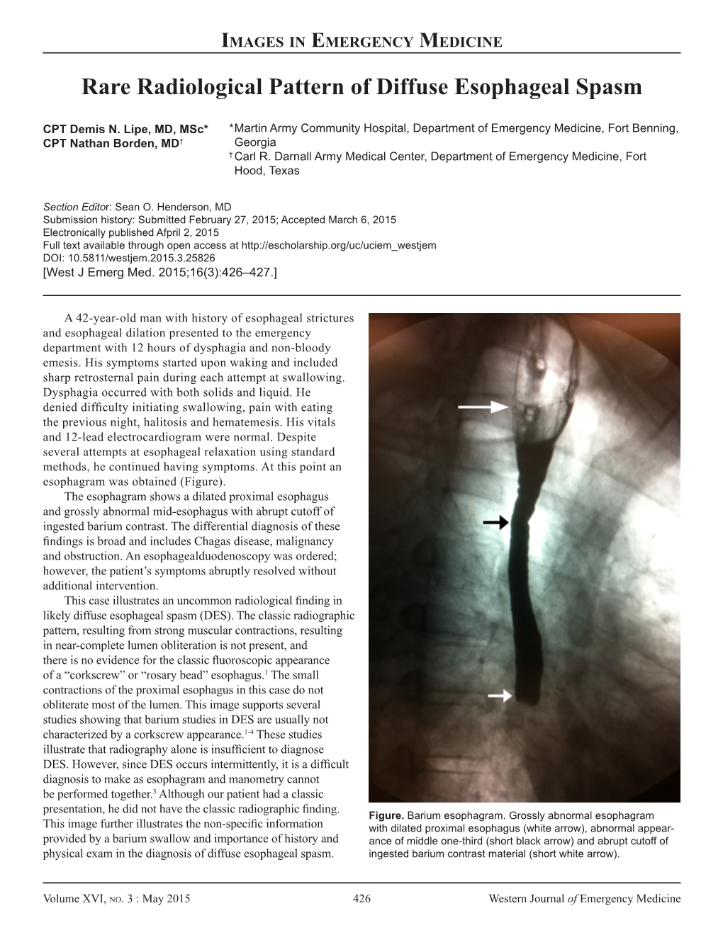 Rare Radiological Pattern of Diffuse Esophageal Spasm