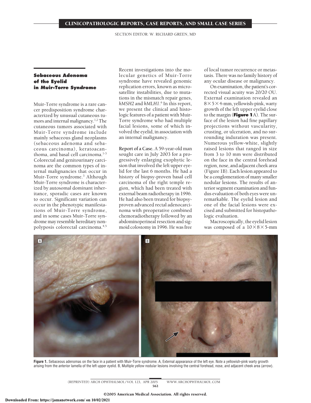 Sebaceous Adenoma of the Eyelid in Muir-Torre Syndrome