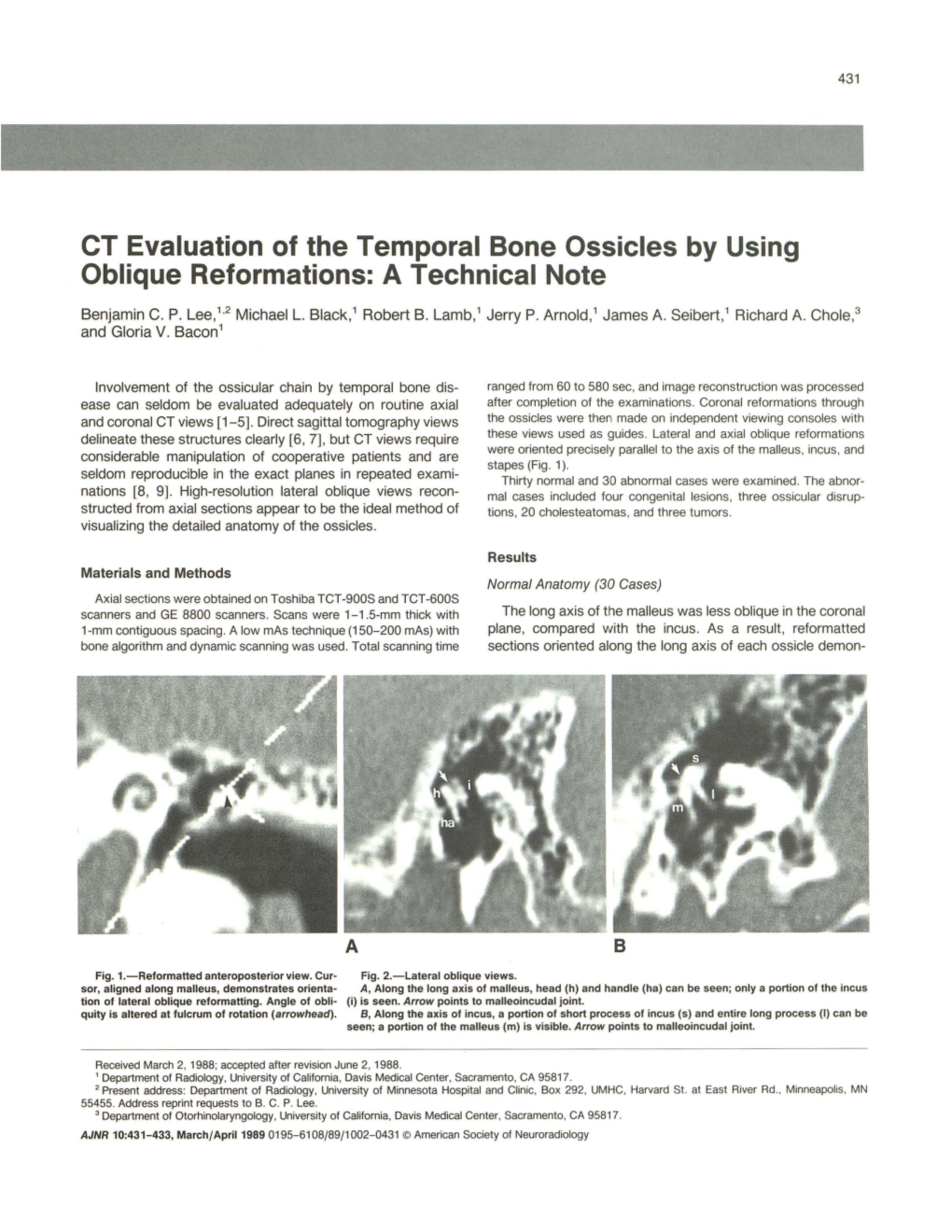 CT Evaluation of the Temporal Bone Ossicles by Using Oblique Reformations: a Technical Note