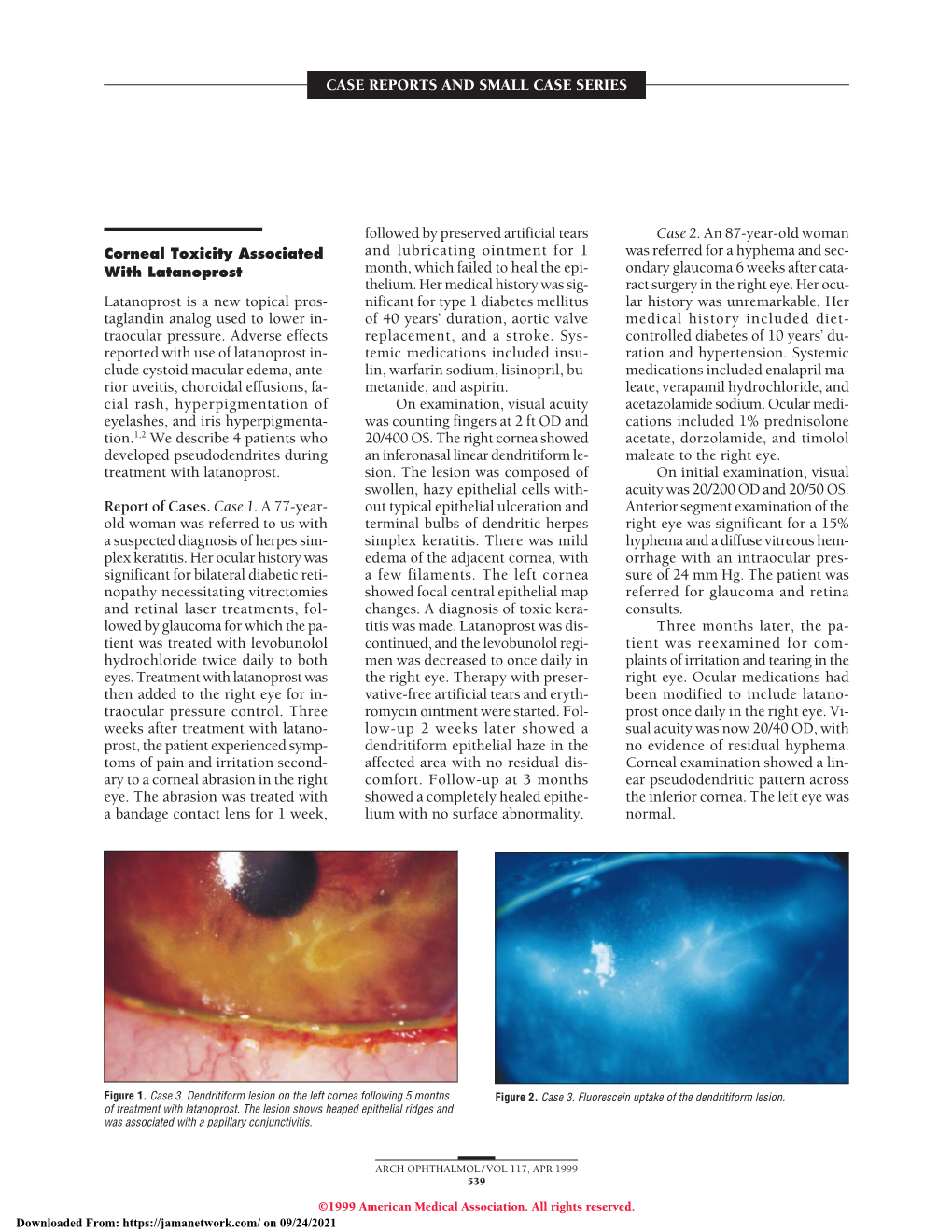 Corneal Toxicity Associated with Latanoprost